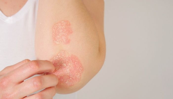 Menopause and Skin Rashes: Causes and How to Manage Them